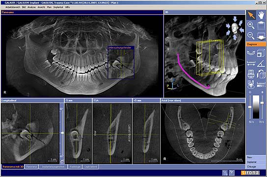 Northeast Oral and Maxillofacial Surgery image of xray from Galileos Cone Beam Scan
